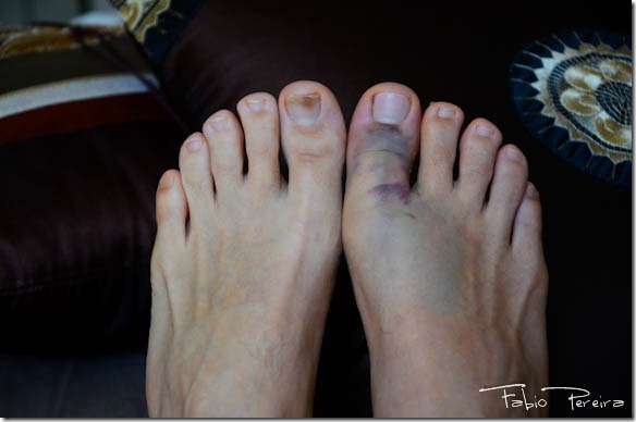 broken toe foot pe quebrado-1