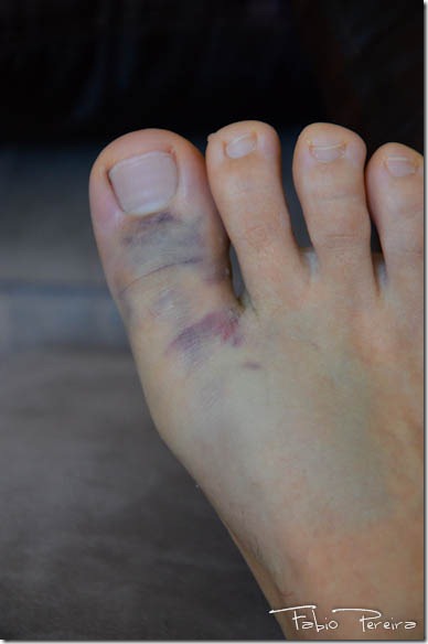 broken toe foot pe quebrado-7